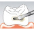 Sonicflex bevel №58 A - насадка для минимально инвазивной терапии кариеса с алмазным покрытием, мезиальная Sonicflex bevel №58 A - насадка для минимально инвазивной терапии кариеса с алмазным покрытием, мезиальная