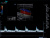 Alpinion E-cube 5 Аппарат УЗИ Alpinion E-cube 5 Аппарат УЗИ